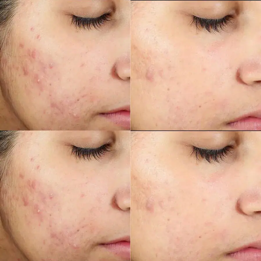 Acne-prone skin, before and after