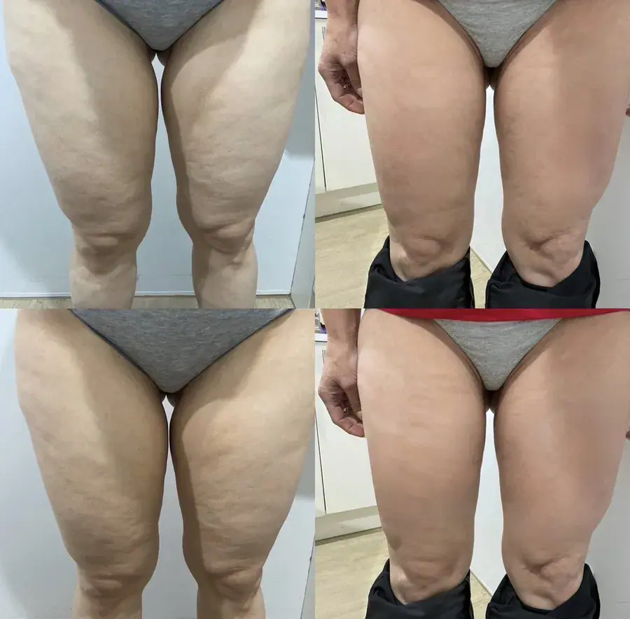 Thighs shown before and after a course of body treatments