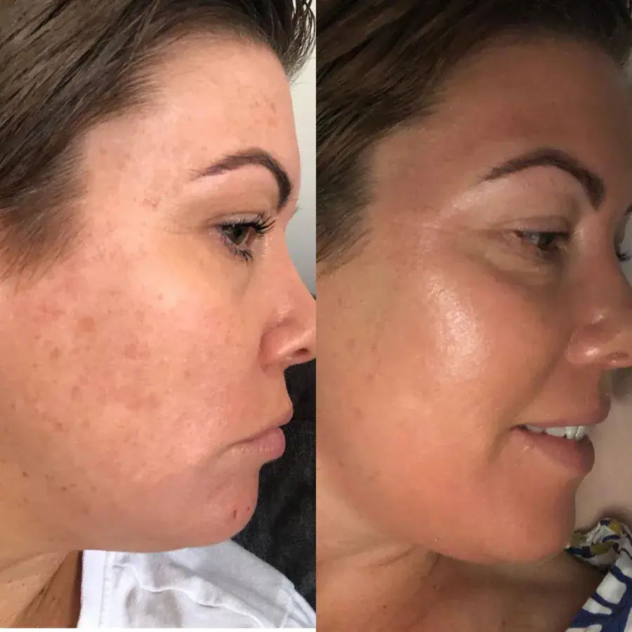 Pigmentation on the face before and after treatment