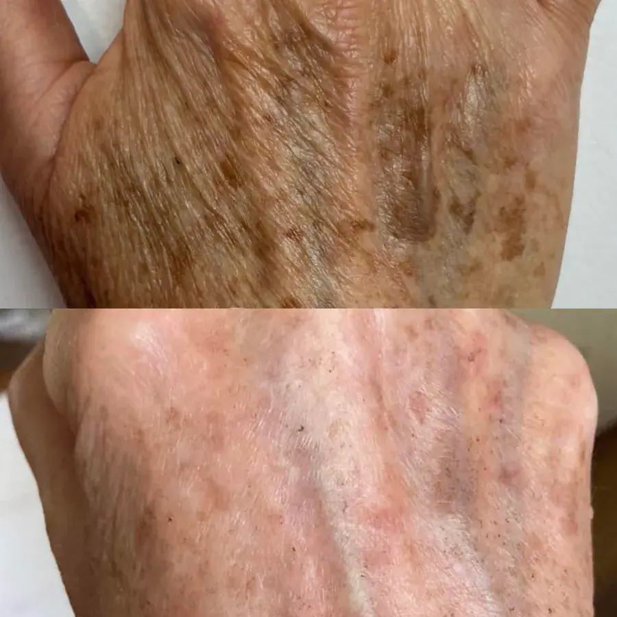 The back of a hand showing sun damage before and after treatment