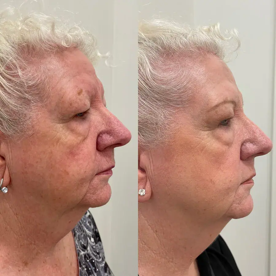 Pigmentation and redness, before and after