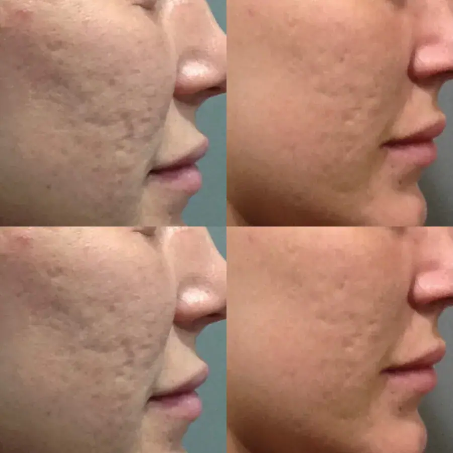 Skin texture and scarring shown before and after treatment