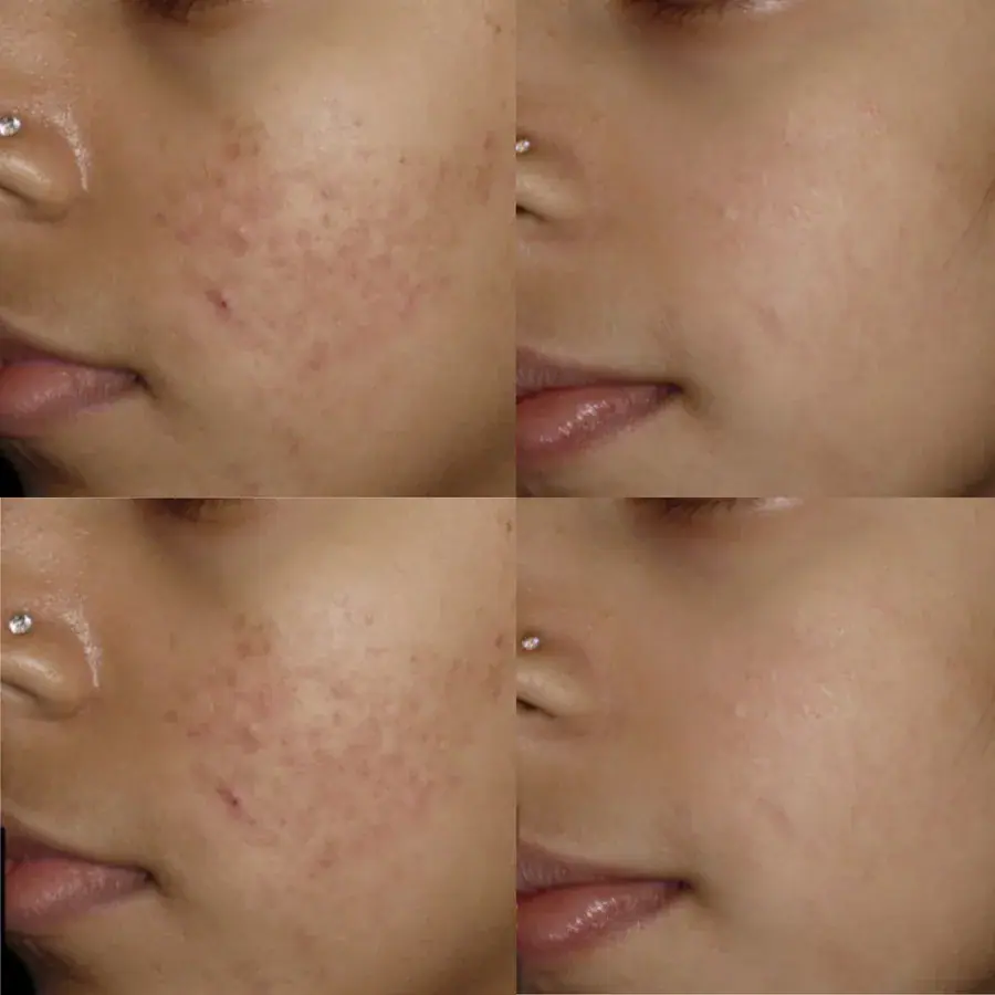 Skin clarity and texture, before and after