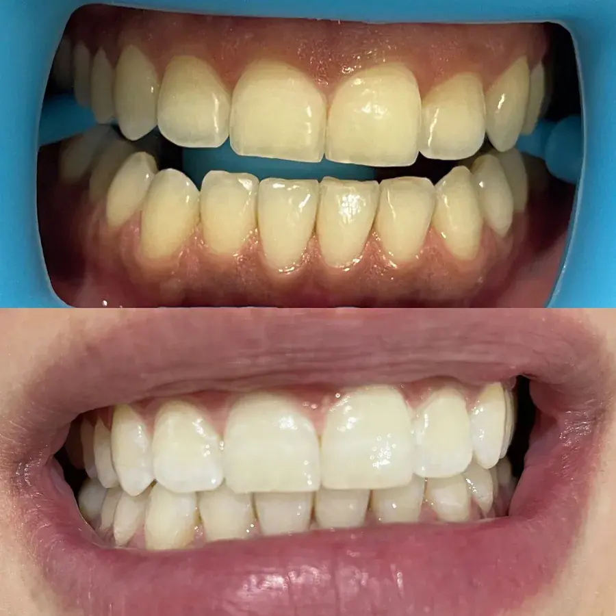 A second set of teeth before and after whitening