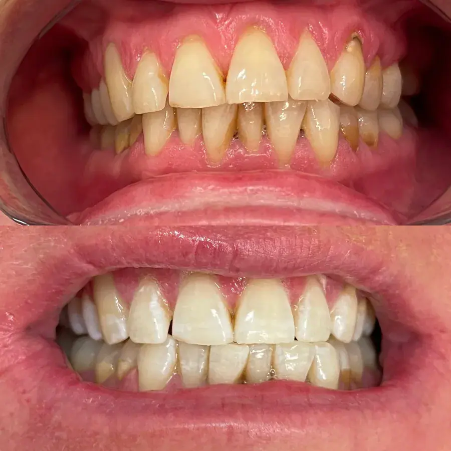 Teeth shown before and after an in-chair whitening session