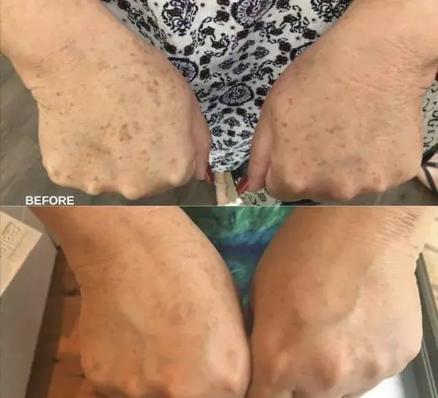 Backs of both hands showing brown pigmentation before and after a course of treatment