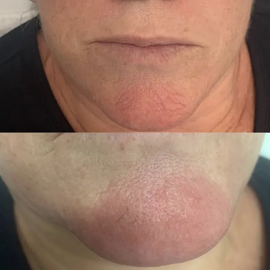 Broken capillaries on the chin shown before and after treatment
