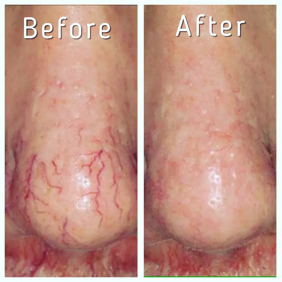 Facial capillaries, before and after