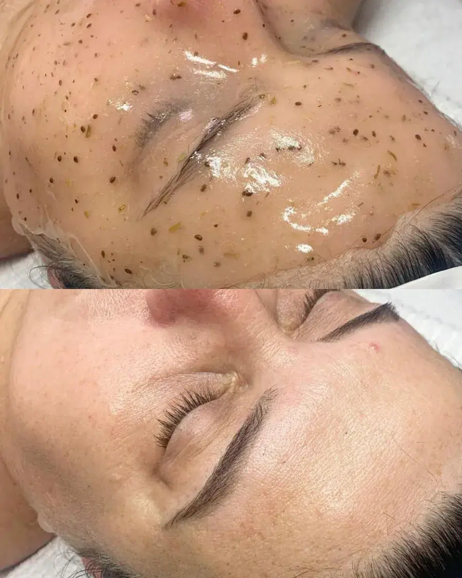 A client during a corrective skin treatment with a mask applied