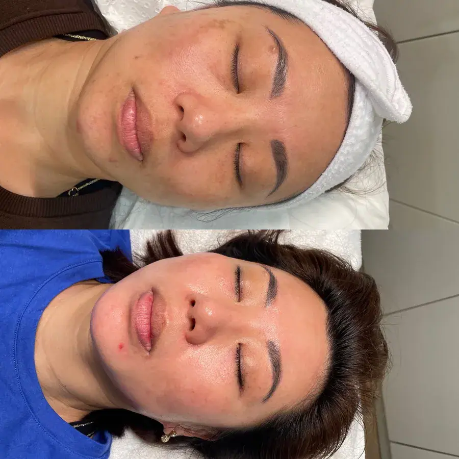 Two clients relaxing with warm towels during facial treatments