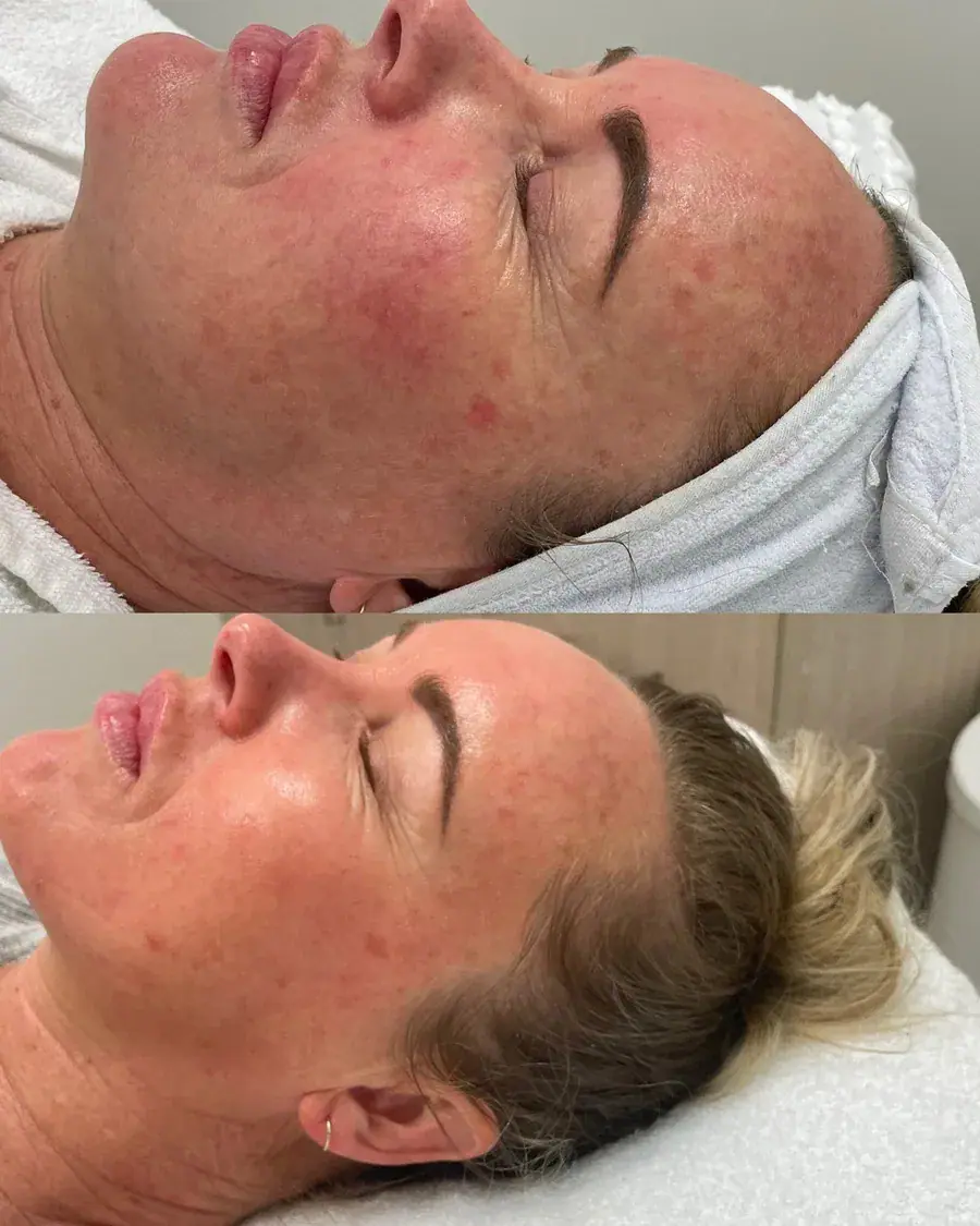 A laser treatment for facial redness in progress