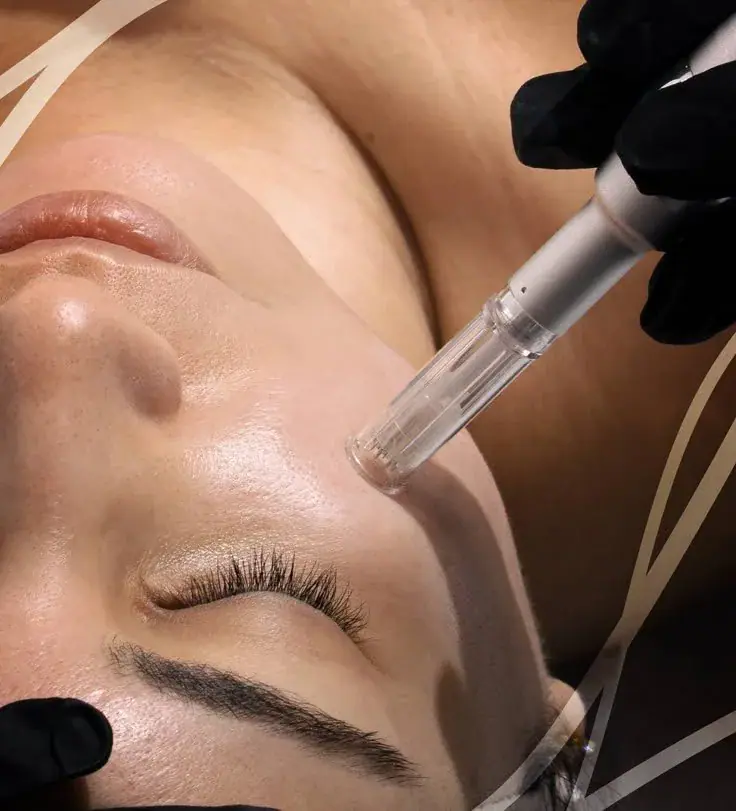 A skin needling treatment being performed across the cheek