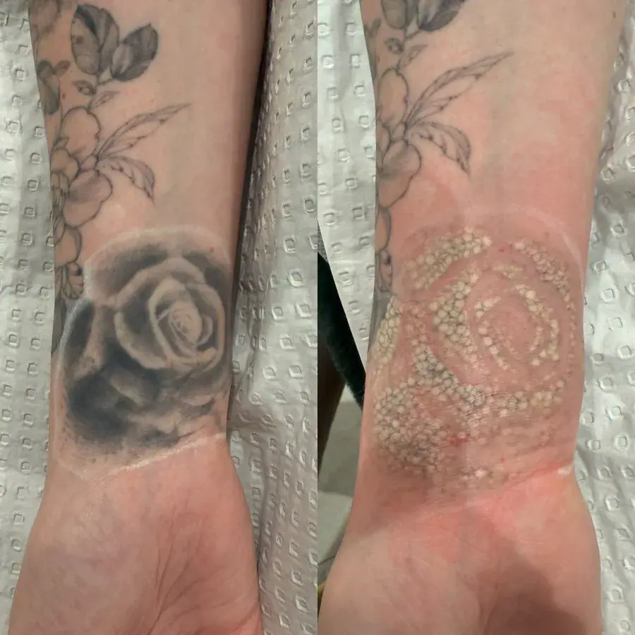 Tattooed forearms showing ink fading across a course of removal sessions