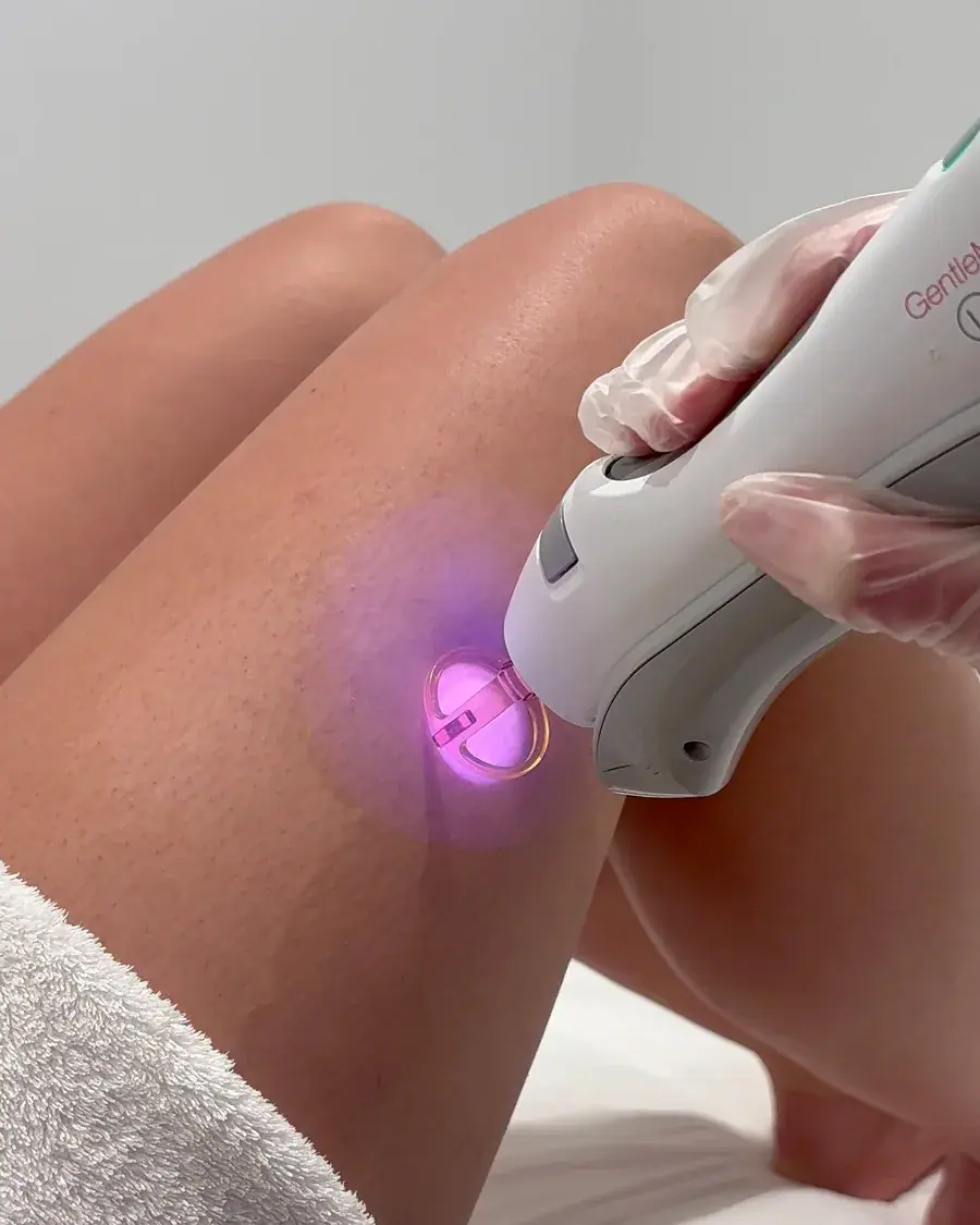 Laser Hair Removal
