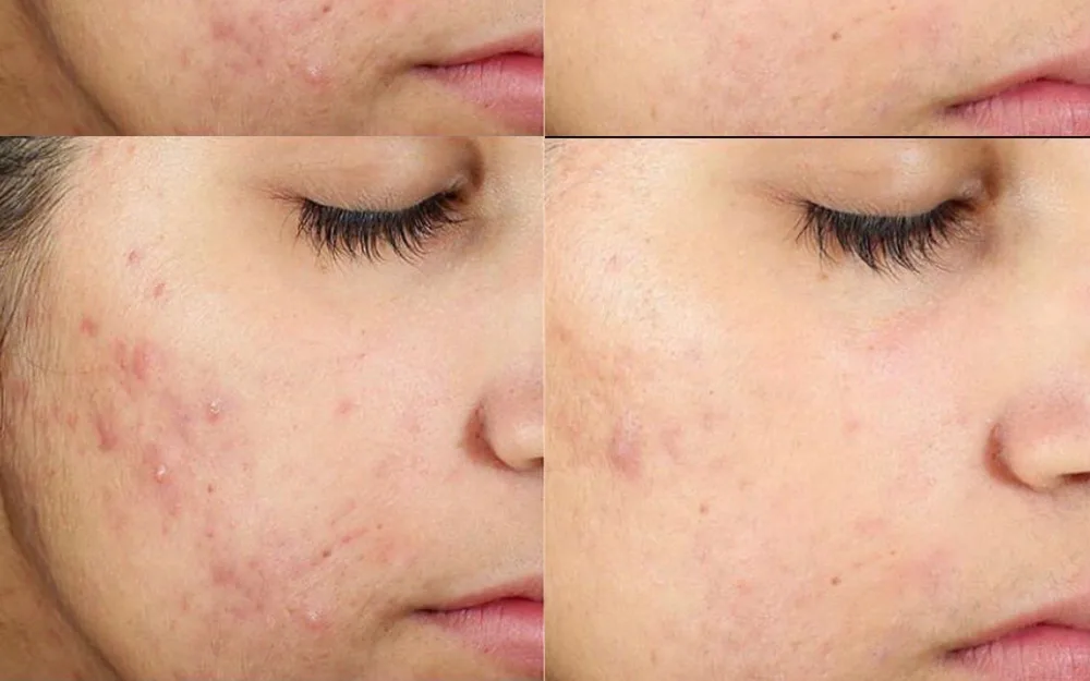 Four close-up views of a cheek with blemish-prone skin